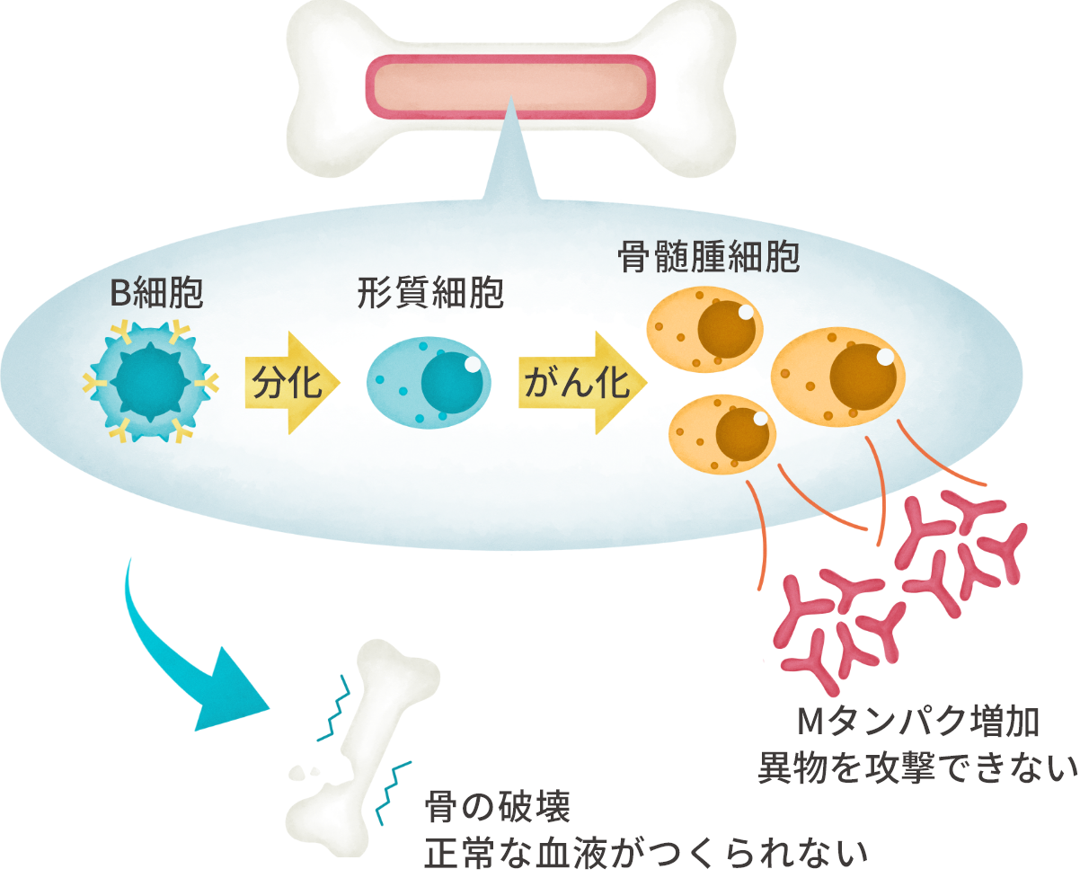 「多発性骨髄腫の骨髄」の説明